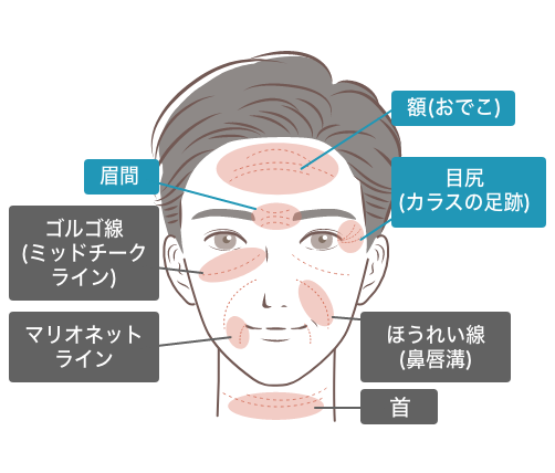 代表的なシワとその種類