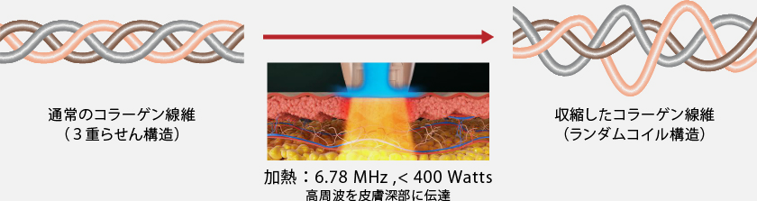 DENSITYのメカニズム