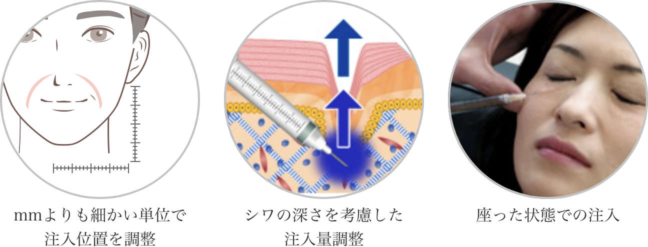 mmよりも細かい単位で注入位置を調整、シワの深さを考慮した注入量調整、座った状態での注入