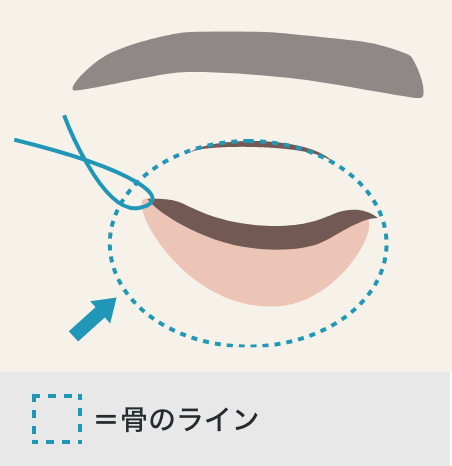 次に、眼輪筋肉を目尻の方へ吊り上げて張りを出し、頬骨の骨膜に固定します