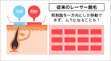 従来のレーザー脱毛