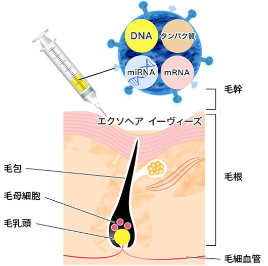 EXOHAIR EVs（エクソヘア イーヴィーズ）を注入