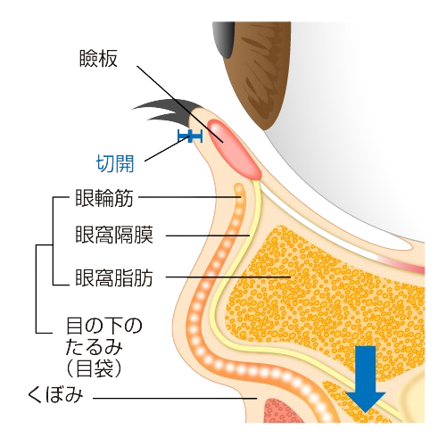 下まつげのすぐ下を切開し、眼窩隔膜より下方にはみ出してくる分だけ眼窩脂肪を切除します。 目の下のくぼみを埋めるように眼窩隔膜と脂肪を移動します