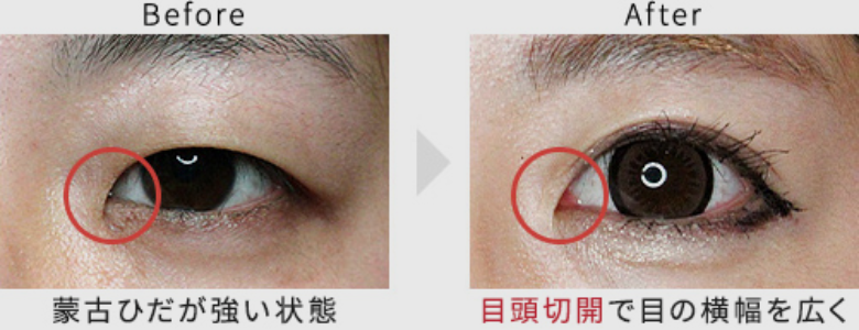目頭切開