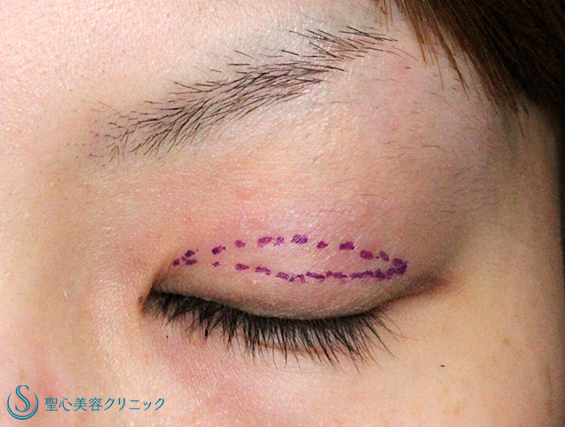 術前デザイン