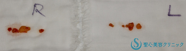 切除脂肪