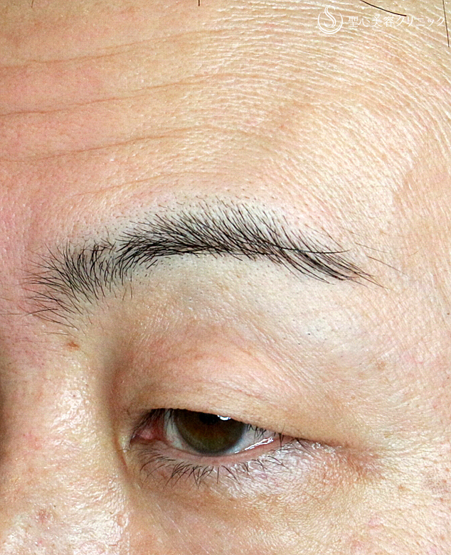 術前斜め